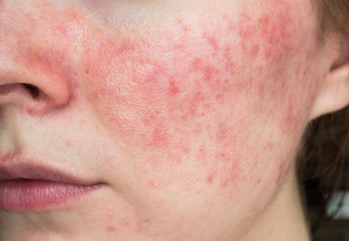 Close up on a woman's face to show her rosacea breaking out 